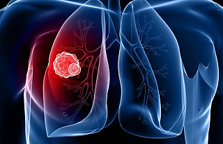 Почему рак лёгких называют «онкокиллером»
