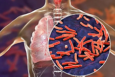 Более десятка пациентов с туберкулёзом выявлено на Островетчине.
